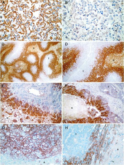 Fig. 4. Immunohistochemical analysis of CA IX expression in cell pellets and tumor biopsies. Sections were stained with anti-CA IX monoclonal antibody M75. A and B,paraffin-embedded cell pellets of normoxic RCC4 and RCC4/VHL respectively. Tumor sections showing the relationship of CA IX expression to regions of necrosis: C and D, head and neck carcinoma; E, breast adenocarcinoma; F, ovarian adenocarcinoma; G, clear cell renal carcinoma from a VHL syndrome patient; H, papillary renal carcinoma. Staining is predominantly membranous. A focal perinecrotic pattern is observed in all tumors except clear cell renal carcinomas. n,regions of necrosis; t, regions of viable tumor cells. A, B, and D–H, ×200; C, ×100.