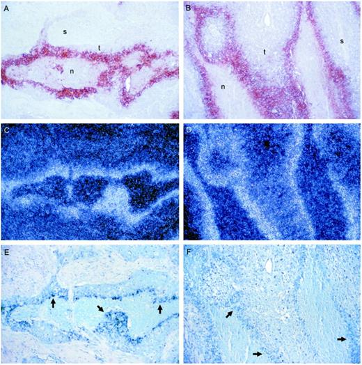 Fig. 5. Comparison of expression patterns for CA IX and VEGF in tumor biopsies. Immunohistochemical detection of CA IX using anti-CA IX monoclonal antibody M75 and in situ mRNA analysis of VEGF is shown. A, C, and E, ovarian adenocarcinoma. B, D, and F, head and neck carcinoma. A and B, CA IX immunostaining. C and D, dark-field views of in situ hybridization for VEGF mRNA on sections serial to the CA IX-immunostained sections. E and F, bright-field views of VEGF in situ. Arrows within necrotic areas (n) in bright-field views point toward the boundary with viable tumor cells. s, stroma; t, regions of viable tumor cells. All panels, ×100.