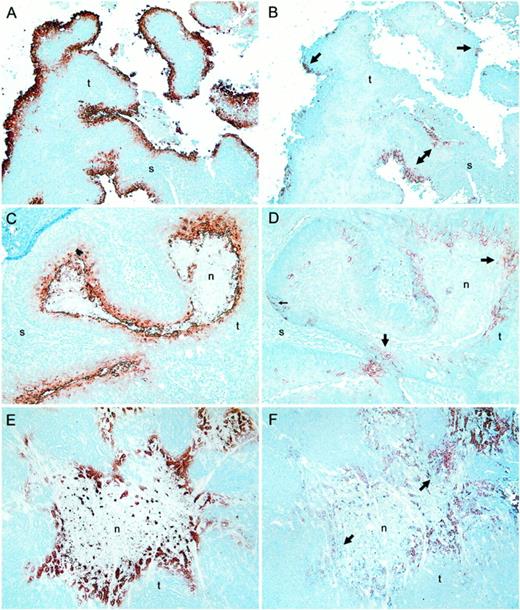 Fig. 6. Comparison of patterns of CA IX expression and pimonidazole adduct formation. A–D, bladder carcinomas; E and F, skin carcinoma. Left-hand panels, pimonidazole immunostaining. Right-hand panels, CA IX immunostaining on semiserial sections. Large arrows within CA IX-stained sections point toward regions of CA IX positivity that overlap with pimonidazole staining. Small arrow (D) highlights region of CA IX positivity farther removed from necrosis than pimonidazole-stained region. n, regions of necrosis; s,stroma; t, regions of viable tumor cells. All panels, ×50.