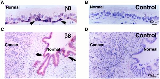 Fig. 1. The β8 subunit is expressed in benign airway epithelium and is absent in lung carcinomas. Paraffin-embedded sections were stained with affinity-purified polyclonal antibodies raised to the β8 cytoplasmic domain (A and C) or to glutathione S-transferase as a control (Band D; Ref. 25). A and B, benign airway from a case of nonneoplastic lung disease. C and D, a case of well-differentiated adenocarcinoma with benign airway adjacent to the carcinoma. Two patterns of airway staining with β8 antibodies are seen. Note that in A, there is predominant basal cell labeling (arrowheads), and in C, there is diffuse staining in all airway epithelial cell types(Normal) including the basal cells(arrows). No staining is observed in the adenocarcinoma(Cancer) or with control antibodies (Band D).