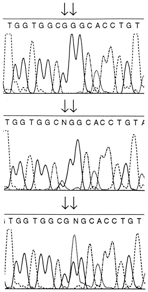 Fig. 2. DNA sequencing electropherogram of the region consisting of a second (presumably constitutive) AciI recognition site. The top sequence represents a wild-type sample with the GCGG motif. The middle sequence shows a laryngeal cancer case with a heterozygous G/A mutation at −297 nt (see Fig. 1<$REFLINK>, Lane 5). The bottom sequencedepicts another laryngeal cancer case with a G/A mutation at −296 nt(see Fig. 1<$REFLINK>, Lane 6). Sequences were verified by reverse sequencing.
