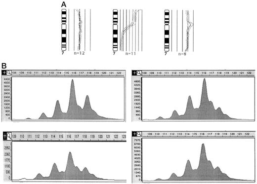 Fig. 1. B, examples of average ratio profiles of chromosome 7 alterations revealed by CGH. The vertical broad central line indicates the fluorescence ratio of balanced DNA sequence copy number state (1.0) between tumor and reference DNA. The vertical lines to the left represent the 0.75 and 0.5 thresholds for losses, the vertical lines to the right represent the 1.25, 1.5, and 1.75 thresholds for gains. The ratio profiles show the mean fluorescence ratio(central) and the 95% confidence limits (leftand right of central line). Chromosome numbers are indicated. B, example of a LOH in intron 1 of the egfr gene. Upper left, heterozygosity in blood lymphocytes; upper right, LOH in invasive breast cancer of the same patient; lower left, LOH in associated DCIS; lower right, LOH in corresponding lymph node metastasis.