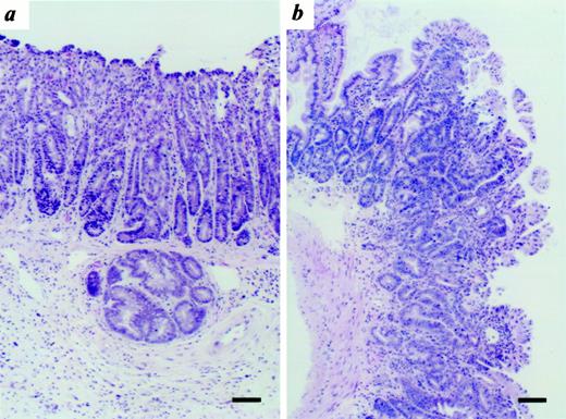 Fig. 4. Tumors seen in Msh3−/− and Msh3−/−;Msh6−/− mice. a, section of GI early invasive adenocarcinoma from a Msh3−/− mouse (bar = 80μm). b, section of early invasive adenocarcinoma from a Msh3−/−;Msh6−/− mouse(bar = 80 μm).