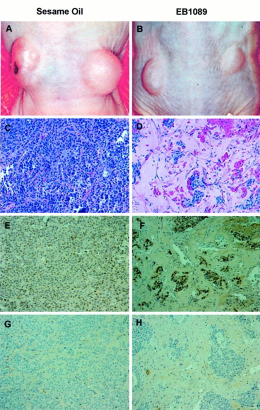 Fig. 3. Analysis of LNCaP tumors. A and B, size comparison in animals receiving injections at two tumor sites and treated as described in Fig. 2<$REFLINK>. A,sesame oil; B, EB1089. Tumors from Fig. 2A<$REFLINK> were harvested, fixed, embedded in paraffin,sectioned onto poly-lysine-coated slides, and used for experiments shown in C–H. Tumor sections C, E, and G are from sesame oil-treated animals; tumor sections D, F, and H are from animals receiving EB1089. Sections C and D were stained with H&E. Immunohistochemistry was performed on sections E, F,G, and H using the human AR antibody AR441. G and H are sections incubated without AR441.