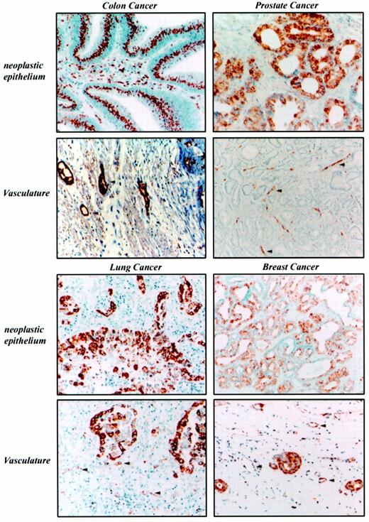 Fig. 1. Immunohistological localization of COX-2 in human cancer. Representative pictures of tissues obtained from 20 patients with cancer of the colon, lung, breast, and prostate were analyzed for the expression of COX-2 using specific antibodies. COX-2-positive stain was observed in 85% of colon, 100% of prostate, 95% of lung, and 88% of breast samples analyzed. It is important to indicate that not all cancer cells express COX-2. In fact, for colon and lung cancers between 40% and 70% of the cancer cells express COX-2. In the cases of prostate and breast, between 5% and 70% of the cancer cells are COX-2 positive. COX-2-positive stain was found in at least 50% of the samples containing angiogenic blood vessels. COX-2 expression is clearly seen (red) in neoplastic epithelium and in some inflammatory cells present within the stroma. COX-2 was also detected in the endothelial cells (red) forming the angiogenic vasculature present within the tumors (arrows).