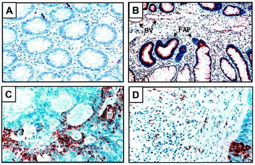 Fig. 2. COX-2 expression in colon oncogenesis. A,COX-2 is generally not found in normal tissues, with the exception of weak expression in some colonic crypt epithelial cells(red, small arrows). B, COX-2 is clearly expressed in the adenomas of FAP patients(red, FAP arrows) and in the blood vessels associated with the adenomas (red, BV arrows). C, striking homogeneity and robust levels of COX-2 immunoreactivity were detected in metastatic lesions in liver in eight of eight colon cancer patients with metastatic disease(red). D, COX-2 was also clearly detected in the vasculature within metastatic tissues and adjacent to neoplastic clusters (red). Similar results were observed in patients with pancreatic cancer, cholangiocarcinoma, and Kaposi’s sarcoma.
