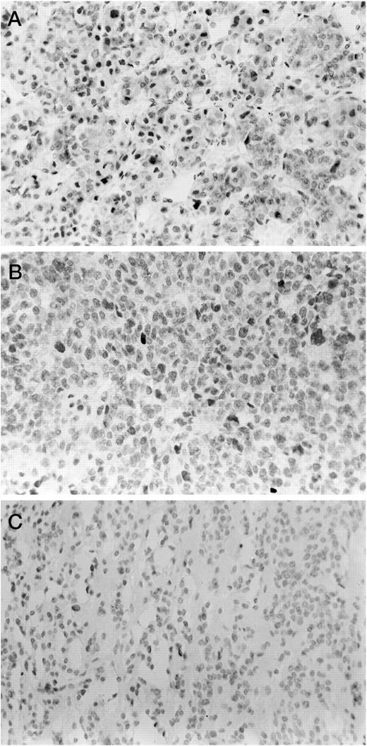 Fig. 1. Immunohistochemical analysis of pRb expression in histologically normal postmortem pituitary and sporadic human pituitary tumors (×370). Only nuclear positivity was assessed; cytoplasmic staining was regarded as nonspecific (See text). A,heterogeneous nuclear reactivity for pRb in normal pituitary. B, nuclear reactivity for pRb throughout the tumor tissue section (no. 132). C, an absence of nuclear pRb immunoreactivity throughout the section in a pituitary adenoma (no. 3).