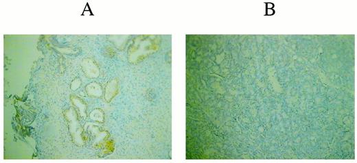 Fig. 4. Carbonyl reductase expression is reduced in advanced prostate cancers. Carbonyl reductase was measured in sections of(A) normal prostate or (B) advanced prostate cancer tissue by immunocytochemistry. The normal prostate section (A) shows staining of the glandular epithelium(orange), which was not seen in the prostate cancer section (B). All experiments included negative controls in which the primary antibody was omitted.