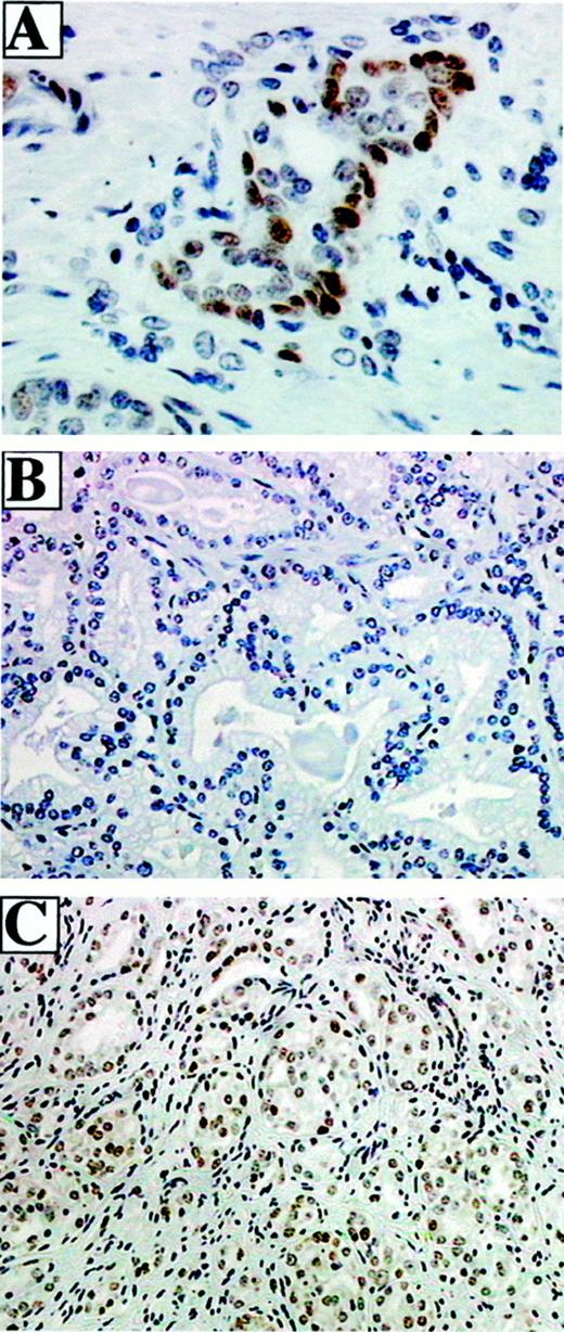 Fig. 1. Representative photomicrographs demonstrating p53 nuclear accumulation in PCa. Immunohistochemical detection of p53 nuclear accumulation was performed using 5-μm thick sections of tumor tissue and DO-7 monoclonal p53 antibody with hematoxylin and light green counterstain (see “Materials and Methods”). A,cluster-positive case with Gleason 4 PCa acinar formation with >12 cells demonstrating p53 nuclear accumulation (brown;×400 magnification). B, PCa Gleason single grade 4 with no nuclei demonstrating p53 nuclear accumulation (×200 magnification). C, PCa Gleason single grade 4 with >70% of nuclei demonstrating p53 nuclear accumulation (×200 magnification).