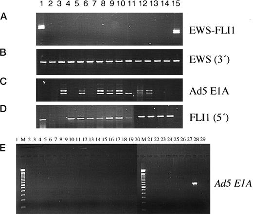 Fig. 1. No evidence for association between EWS-FLI1 expression and E1A is shown by PCR. RT-PCR for (A) EWS-FLI1,(B) germ-line EWS, (C) Ad5 E1A, and(D) germ-line FLI1 expression is shown. In A, the two bands typically resulting from EWS-FLI1 amplification in a one-tube nested PCR of Ewing tumor RNA correspond to the first- and second-round products. In C, the two bands obtained in E1A RT-PCR represent the variably spliced isoforms 289R and 243R. A–D, HeLa, HS68, and SJ-NB-7 before (Lanes 2, 4, and 6) and 70 h after (Lanes 3, 5, and 7) lipofection with an Ad5 E1A expression plasmid, respectively, HEK293 (Lane 8), EcR293 (Lane 9), HER911 (Lane 10), PER.c6 in passage 9 (Lane 11) and 122(Lane 12), HER-RIC.c4 (Lane 13),HER-RIC.c7 (Lane 14), EFT cell lines VH64 and SK-N-MC(Lanes 1 and 15, respectively). E, PCR for Ad5 E1A sequences in genomic DNA of EFT cell lines. Lanes 1–27, A673, IARC-EW2, IARC-EW7, RDES,SAL2, SK-ES1, SK-N-MC, SMB, STA-ET-1, STA-ET-2.7, STA-ET-2.2, STA-ET-3,STA-ET-4, STA-ET-5, STA-ET-6, STA-ET-7.1, STA-ET-7.2, STA-ET-7.3,STA-ET-8.1, STA-ET-8.2, STA-ET-9, STA-ET-12, STA-ET-14, TC252, VH64,WE68, WE-M2–68, respectively. HEK293 (Lane 28)served as a positive control. Lane 29, water control, Lane M, size marker.