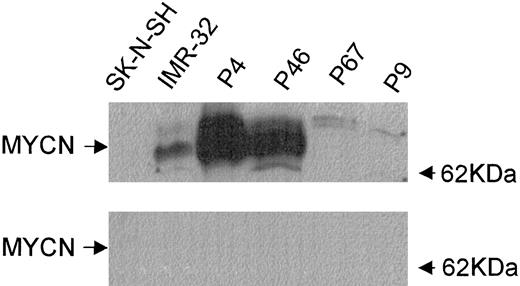 Fig. 1. Immunoblot for MYCN protein in neuroblastoma cell lines SK-N-SH, IMR-32, and tumor cell primary cultures from patients P4, P46,P67, and P9. Equal amounts of cell lysate (25 μg of protein) were subjected to electrophoresis on an 8.5% SDS-PAGE gel, transferred to a nitrocellulose membrane, and probed with either an anti-MYCN mAb and HRP-labeled goat anti-mouse secondary Ab (upper blot) or HRP-labeled goat antimouse secondary Ab alone (lower blot). SK-N-SH and IMR-32 served as negative and positive controls, respectively, for MYCN protein.
