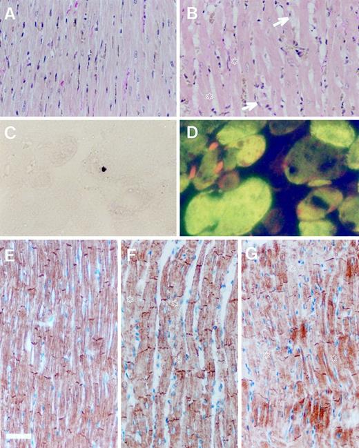 Fig. 1. van Gieson-stained sections of rat myocardium from a control animal (A) and 24 h after a single injection of 2.5 mg/kg DOX (B). Note the vacuolization of cardiomyocytes (arrows) and edema (∗) in B. C, dark brown-colored TUNEL-positive nucleus in a sample obtained 24 h after injection of 2.5 mg/kg DOX. Note the condensation of the nucleus and shrunken appearance of the cell. D, double staining with antimyosin shows the same nucleus located within the cardiomyocyte. E–G,immmunohistochemical staining for desmin. E, control rat myocardium; F, myocardium after a single injection of 2.5 mg/kg DOX; G, myocardium after the cumulative DOX dose of 15 mg/kg and a follow-up for 7 days. Note the gradual decrease in the intensity of staining and disorganization of cross-striated staining pattern (∗). Magnification: A, B, E–G, ×200; bar = 50 μm; C and D, ×1000; bar = 10μm.