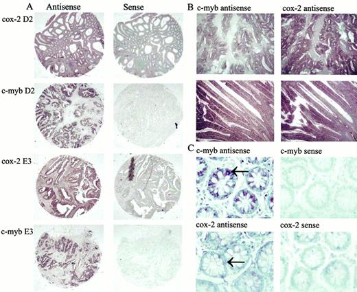 Fig. 1. In situ hybridization of tissue arrays generated from fully characterized paraffin-embedded CRC specimens. Sections were hybridized with either sense or antisense probes corresponding to COX-2 and c-MYB cDNA. A, hybridization of sense and antisense probes to core D2 and E3 cut at different planes within the same blocks (×25). B, hybridization of consecutive sections of the same biopsy specimens showing colocalized hybridization of c-MYB and COX-2 (×100). C, hybridization of specimens showing restricted expression of c-MYB and COX-2 to the columnar cells of colonic crypts (arrows; ×630). Notably, this level of expression was considerably lower than that observed in adjacent tumor samples.