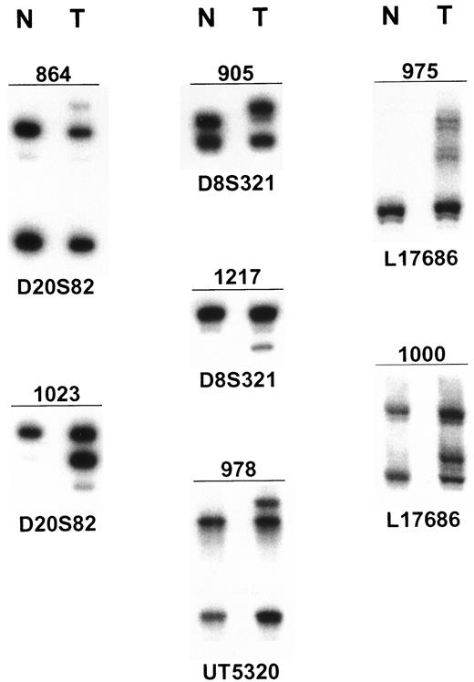 Fig. 1. Identification of MSI in NSCLC. MSI (insertion or deletion of repeat units) in tumor (T) compared to nonneoplastic DNA (N).