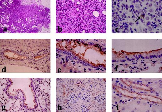 Fig. 1. Immunohistochemical and H&E staining of various tissues of MUC-1 transgenic mice stained with an antibody (HMFG-1) reactive with human mucin. a, inflammatory infiltrate at the site of injection of E3-IL-12 cells into breast tissue of MUC-1 transgenic mice. H&E section, ×250. b, inflammatory infiltrate at the site of injection of E3-IL-12 cells into breast tissue of MUC-1 transgenic mice. H&E section, ×400. c, inflammatory infiltrate and a mucin-positive breast cancer cell(arrow) in breast tissue from MUC-1 transgenic mice injected with E3-IL-12 cells. Immunohistochemical staining, ×400. d, immunohistochemical staining of portal tracts in the liver of MUC-1 transgenic mice with immunostaining localized to bile duct epithelium. ×400. e, immunohistochemical staining of portal tracts in the liver of MUC-1 transgenic mice, showing strong luminal surface staining. ×1000. f, immunohistochemical staining of bronchial epithelium of MUC-1 transgenic mice. ×1000. g, immunohistochemical staining of bronchial epithelium of MUC-1 transgenic mice. ×400. h, immunohistochemical staining of renal cortex of MUC-1 transgenic showing reaction with cells in the distal convoluted tubules. ×400. i,immunohistochemical staining of renal cortex of MUC-1 transgenic mice showing reaction with cells in the distal convoluted tubules. ×1000X. For the immunohistochemical staining, the tissues were fixed in methanol:chloroform:acetic acid (60:30:10) and paraffin embedded for sectioning. Dewaxed paraffin sections were incubated with 50% FCS in PBS for 30 min to prevent nonspecific binding of antibodies. The blocking solution was then removed and replaced by neat hybridoma culture supernatant, followed by incubation at room temperature for 60 min. After three 5-min washes with PBS, the sections were incubated for 1 h with peroxidase-conjugated rabbit antimouse immunoglobulin antiserum (Dako; diluted 1:50 in PBS with 15% FCS). The slides were then washed three times with PBS. The substrate solution consisting of 0.03% hydrogen peroxide in PBS and 1 mg/ml diaminobenzidine (Sigma)was added, and the reaction was allowed to continue for 5–8 min. After final washing with PBS, the slide were counterstained with H&E and mounted.