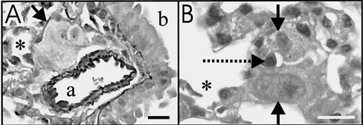 Fig. 1. Extravasated B16F10 melanoma cells in mouse lung after venous injection (4-μm thick sections; bars, 15 μm). A, Verhoeff’s stain clearly shows elastin layers around arteriole (a) adjacent to bronchiole (b),4 days after injection. Melanoma cells (arrow, confirmed by S100 staining in adjacent sections) in tissue between arteriole and alveolar space (∗). B, H&E stain shows melanoma cells(solid arrows) surrounding capillary containing RBCs(broken arrow), 1 day after injection, indicating that cells were extravascular. ∗, alveolar space.