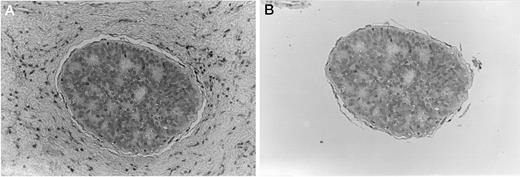 Fig. 1. Microdissection of stromal cells close to the epithelial component. Magnification, ×200. A, before microdissection. B, after microdissection.