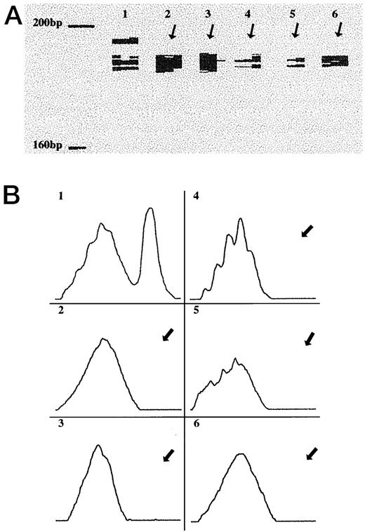 Fig. 2. A, LOH on chromosome 17q(D17S785; expected size, 181–207 bp) in SC-IDC(Lane 2), SC-DCIS (Lane 3), clear-cut normal epithelial cells (Lane 4), DCIS (Lane 5), and IDC (Lane 6). Lane 1,normal SAD from DCIS or IDC. B, graphical(densitometric) representation of lanes seen in A.