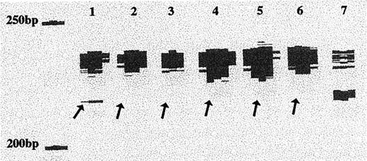 Fig. 3. LOH on chromosome 3p (D3S1300; expected size, 217–241 bp) in SAD (Lane 1), SC-IDC (Lane 2), SC-DCIS (Lane 3), epithelium with mild cytological atypia (Lane 4), DCIS (Lane 5), and IDC (Lane 6). Lane 7,clear-cut normal epithelium (normal ducts and ductules).