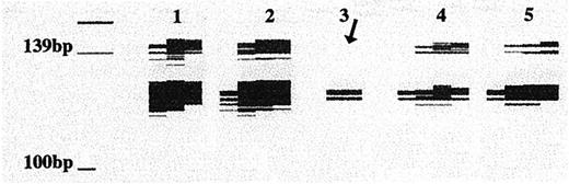 Fig. 4. LOH on chromosome 11q (D11S1311; expected size, 127–147 bp) in SC-DCIS (Lane 3). using the polymorphic marker D11S1311, normal SAD from DCIS(Lane 1), fibrotic SAD from DCIS (Lane 2), morphologically normal epithelial cells (Lane 4), and DCIS (Lane 5) are not associated with LOH.