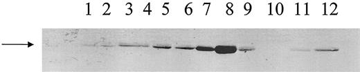 Fig. 2. E2F-1 protein levels as determined by Western blot analyses of lysates prepared from tumor samples of both lung (L) and hepatic (H) metastases. Lanes 1–5, samples H2, H5, H7,H8, and H12, respectively; Lanes 6–12, L2, L3, L4, L5,L6, L7, and L8, respectively.