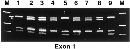 Fig. 3. Germ-line deletions of the TβR-I gene in OC detected by PCR-SSCP. Arrows, full-length and deleted forms of exon 1. Lanes 1, 5, and 9, wild type for exon 1; Lanes 2–4 and 6–8, cases with germ-line deletion of exon 1, and they are all heterozygous del(GGC)3 carriers. Lanes 7 and 8 are from right and left ovaries of the same case.