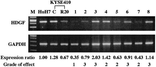 Fig. 3. Representative cases of the amplified HDGF and GAPDH expression and expression ratios are shown. The expression ratio was calculated as the expression of HDGF adjusted by the GAPDH expression, using computer-assisted image analysis, in each case compared with that in HuH-7. The grade of the radiotherapy effect was determined based on the histopathological criteria of the Japanese Society for Esophageal Diseases. Grade 0, ineffective; Grade 1, slightly effective, more than one-third of the cancer cells are viable; Grade 2, moderately effective, less than one-third of the cancer cells are viable; Grade 3, markedly effective, there are no viable cells of cancer.
