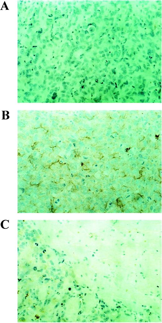 Fig. 6. Influenza virus-specific immunostaining of 518-L1 tumors in SCID mice after delNS1 virus inoculation. Tumors were grown to a diameter of ∼1 cm. One × 106 pfu of delNS1 virus were injected into the tumor mass. Tumors were excised and processed for immunostaining after 48 h (×40). A, center of the tumor after saline injection; B, center of the tumor after delNS1 virus injection. C, edge of the tumor (left) and adjacent muscle tissue (right) after delNS1 virus injection.
