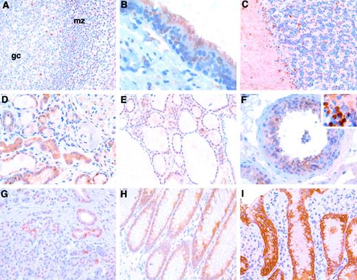 Fig. 4. Immunohistochemical staining of FOXP1 protein in normal tissues. In A, tonsil shows positive nuclear JC12 staining in some cells in the germinal center (gc) and the majority of cells in the mantle zone (mz). B, bronchial epithelium from the lung, showing nuclear staining of epithelial cells. C, cerebellum showing nuclear expression in approximately half of the cells in the granular layer and weak cytoplasmic staining. D, kidney showing cytoplasmic positivity in the proximal tubules and heterogeneous nuclear expression in the distal tubules and collecting ducts. E, heterogeneous nuclear staining in thyroid. F, testis showing both nuclear and cytoplasmic staining with a capped localization on the spermatids (visible in the high-power inset from a frozen section). G, nuclear labeling of exocrine acini and ductal epithelial cells in the pancreas. H, colon showing weak to moderate predominantly nuclear staining of cells in the base of crypts. I, fundic-type mucosa from the stomach showing strong cytoplasmic staining of foveolar epithelial lining while nuclear staining is visible in small lymphocytes in the lamina propria.