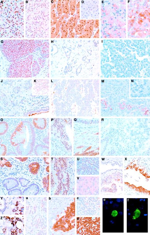 Fig. 5. Immunohistochemical staining of FOXP1 protein in neoplastic tissues. Renal clear cell carcinomas without (A) and with (B) VHL disease showing nuclear positivity with antibody JC12. Renal chromophobe tumors showing either strong cytoplasmic and nuclear labeling (C) or weak heterogeneous nuclear staining (D). Renal clear cell (E) and papillary tumors (F) with cytoplasmic positivity. Breast carcinoma in situ (G) and breast ductal carcinoma (H) showing nuclear labeling while the breast ductal carcinoma in I was negative. Small cell lung carcinomas showing normal (J and K) to weak (L) nuclear staining. Note the curious para-apical distribution of the FOXP1 protein in the bronchial epithelium (J). Patchy cytoplasmic labeling of a squamous non-small cell lung tumor (M). Negative non-small cell lung adenocarcinoma (N). The transition from normal (left) to neoplastic epithelium (right) from a tubulovillous colon adenoma (with foci of in situ carcinoma, not illustrated; O). Heterogeneous nuclear and cytoplasmic JC12 staining in a well-differentiated colon adenocarcinoma with mucinous differentiation (P and O) containing ribbons of poorly differentiated neoplastic cells (Q, bottom). R, poorly differentiated colon adenocarcinoma exhibiting no labeling of the neoplastic cells (right), while the base of nonneoplastic crypts have weak nuclear positivity. S, stomach base of foveolae with intestinal metaplasia showing loss of cytoplasmic staining. T, well-differentiated stomach adenocarcinoma, intestinal type, with strong nuclear and weak cytoplasmic labeling. Head and neck tumors showing nuclear labeling in an undifferentiated carcinoma (U) and cytoplasmic labeling of an SCC case (V). Prostate biopsy showing PIN with weak cytoplasmic positivity (bottom) and negative normal glands (W, top). Intense cytoplasmic staining in intraductal spreading of an otherwise infiltrating prostate carcinoma (X). Variation within the same prostate carcinoma case showing strong nuclear (Y) and heterogeneous strong cytoplasmic or negative (Z) labeling in different areas of the tumor. Pancreatic tumors showing either weak nuclear (a) or strong cytoplasmic labeling (b) of the neoplastic cells. DLBCLs (c and d) showing largely negative (c) or strong (d) nuclear labeling of the tumor cells. Note the positive normal lymphocytes in the negative case (c). Immunofluorescent staining for FOXP1 (green) in COS cells transfected with either pAB195 (e) or pAB196 (f) and counterstained with 4′,6-diamidino-2-phenylindole (blue).