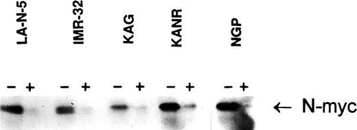 Fig. 3. Effect of DFO on cellular N-myc protein in neuroblastoma cell lines. Five human neuroblastoma cell lines were cultured in RPMI 1640 + 10% FBS. Western blotting was performed as described in Fig. 2<$REFLINK>. Cultures were exposed to 50 μm DFO or water for 24 h. The same experiment was repeated more than three times. Minus, control; plus, 50 μmDFO.