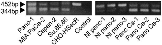 Fig. 2. RT-PCR evidence of secretin receptor expression in pancreatic cancer. Total RNA was isolated from four pancreatic cancer cell lines, the human secretin receptor-expressing CHO-HSecR cell line, and from tumors (Panc Ca) and surrounding normal pancreas (Nl panc) in three patients with ductular pancreatic carcinoma. The negative control included no cellular RNA. Samples were analyzed by RT-PCR, as described in “Materials and Methods.” Products were separated on 1% agarose gels, yielding two distinct cDNA bands in each of the pancreatic cancer samples, with only the larger of these observed in the wild-type control, and with no bands in the control lane. Images are representative of three similar experiments.