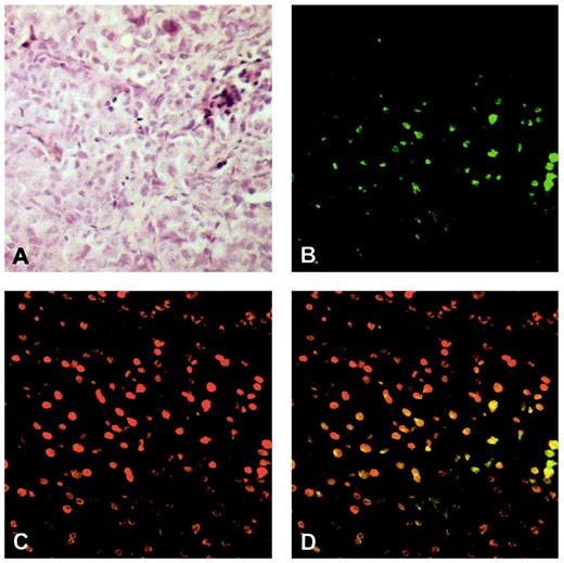 Fig. 4. Histology of IGROV-1 tumors in SCID mice and EGFP expression by confocal microscopy analysis. Tumor sections were in part stained with H&E (A) or fixed and subjected to indirect immunofluorescence (B–D). Fixed sections were stained with mouse antihuman nucleoporin p62 and rabbit anti-GFP, followed by Alexa 594-conjugated goat antimouse and Alexa 488-conjugated goat antirabbit secondary antibodies before being analyzed by confocal microscopy. Staining with H&E disclosed that IGROV-1 cells grew in SCID mice as solid tumors with limited infiltration of inflammatory or other host cells (A). In confocal laser scanning images of tumor sections, the green signals correspond to GFP (B), whereas red signals correspond to the nuclear staining determined by Nup62 (C).Yellow signals generated in the overlay (D) show the colocalization of GFP and Nup62, highlighting the diffuse presence of GFP+ cells in the tumors injected with the lentiviral vector.
