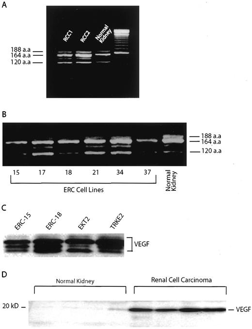 Fig. 3. Identification of VEGF isoforms expressed in rat RCC. A, RT-PCR of mRNA from Eker rat RCC and normal kidney. B, gel electrophoresis of RT-PCR of RCC-derived cell lines: ERC15, -17, -18, -21, -34, and -37. Expected VEGF amplification products of 408, 540, and 601 bp correspond to VEGF isoforms VEGF120, VEGF164, and VEGF188, respectively. C, immunoblot of total cell lysates from rat RCC-derived cell lines (ERC) and transformed rat kidney epithelial cells (EKT2 and TRKE2). Antibodies used recognized three isoforms of VEGF: 120, 164, and 188 aa. D, VEGF protein expression in rat RCC. Immunoblot of total cell lysates from seven Eker rat RCC (three; data not shown) and four normal kidney samples under denaturing conditions.