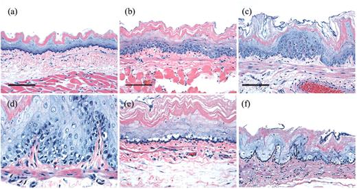 Fig. 1. Photomicrographs of fixed and stained esophagus sections illustrating the classification scheme (bar = 100 μm). Typical example of normal epithelium (a), LGD (b), HGD (c), epithelium with apoptotic bodies (d), and epithelium with vacuolated cells (e). The photomicrograph shown in f shows a case which was classified as containing apoptotic bodies but which also contained a significant number of normal epithelial cells.
