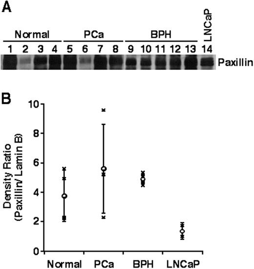 Fig. 4. Presence of paxillin in nuclear matrix fractions of human prostate tissue. Nuclear matrix fractions derived from normal prostates, prostate cancer (PCa), benign prostate hypertrophy (BPH), or LNCaP cells were subjected to Western blot analysis using an anti-paxillin antibody (A) or lamin B antibody (not shown). The ratio of paxillin/lamin B density on individual Western blots is shown (B).