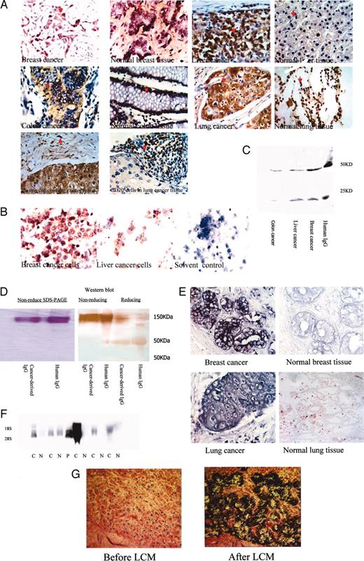 Fig. 1. IgG expression in cancer cells and in proliferating epithelial cells. A, IgG expression in epithelial cells in normal and cancerous tissues from breast, liver, colon, lung, and tumor-infiltrating plasma cells were examined by immunohistochemistry using the antibody against human IgG; CD20 expression on tumor-infiltrating B lymphocytes were examined immunohistochemically using the antibody against human CD20. B, IgG expression in purified cancer cells from breast and liver were examined immunocytochemically using the antibody against human IgG. C, SDS-PAGE and Western blot analysis were performed, and the cancer-derived IgG was observed in purified breast, liver, and colon cancer cells. D, IgG from purified lung cancer cell was extracted and purified by ion exchange chromatography on CM-Sepharose and detected by Western blotting. E, in situ hybridization of a cRNA segment of IgG in breast and lung cancer. F, Northern blot analysis of IgG mRNA in 5 lung cancer tissue samples and in 5 normal tissue samples adjacent to the tumor with a cDNA segment of IgG Fc as the probe. C, lung cancer tissue; N, normal lung tissue; P, peripheral blood mononuclear cells. G, single-cell RT-PCR analysis, after the frozen lung cancer sample slice was stained with H&E, single cancer cells were captured. H, the PCR product from single cancer cells was cloned into pGEM-T Easy Vector (Promega), and three clones were sequenced.