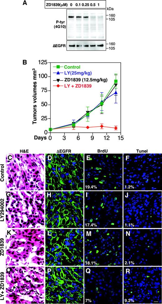 Fig. 6. ZD1839 and LY294002 show combinatorial efficacy on growth of U87:ΔEGFR tumor xenografts. A, U87:ΔEGFR cells were treated with 0.1–1 μm ZD1839 for 24 h. Cells were harvested and lysed. Cellular proteins were resolved by 4–20% SDS-PAGE, transferred to nitrocellulose, and immunoblotted with antibodies to P-Tyr (4G10) and to EGFR/EGFRv3 (Ab5). B, U87MG cells transduced with ΔEGFR (1 × 106) were injected s.c. in BALB/c nu/nu mice and allowed to establish for 8 days (6–10 mm3 in size). Starting on day 0 of the graph shown, animals with established tumors were treated once daily with either DMSO (control-delivered i.p.), 25 mg/kg LY delivered i.p., 12.5 mg/kg ZD1839 administered p.o., or 25 mg/kg LY plus 12.5 mg/kg ZD1839. Each data point represents the mean tumor volume ± SE obtained from five mice. C–R, ZD1839 and LY294002 inhibit proliferation and induce apoptosis. On day 14 of treatment, two mice in each group were randomly selected and pulsed with BrdUrd (BrdU) before tumor harvesting. Tumor sections were stained with H&E (C, G, K, and O). Arrows in O show increased pyknotic nuclei in response to LY + ZD1839. Tumor sections were also stained with an antibody to EGFR/ΔEGFR (Ab5; green in D, H, L, and P), antibody to BrdUrd (green in E, I, M, and Q), or with fluorescein-labeled (green) dUTP in conjunction with a terminal deoxynucleotidyl transferase-mediated nick end labeling (TUNEL) assay (green in F, J, N, and R). Nuclei were counter-stained with To-Pro-3 iodide (blue) and visualized by confocal laser scanning microscopy. BrdUrd-positive and TUNEL-positive nuclei were counted in 10 high-power microscopic fields. Numbers denote the percentage of BrdUrd-positive and TUNEL-positive nuclei relative to the total number of tumor cell nuclei in the same fields. Scale bar corresponds to 100 μm.