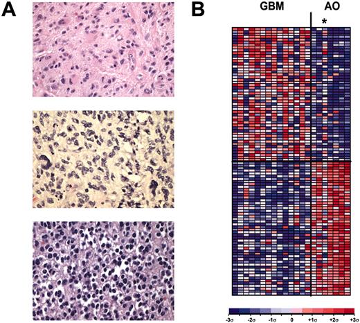 Fig. 1. Characterization of classic high-grade gliomas. A, histological features of classic high-grade gliomas. “Brain_CG_3” (top), classic glioblastoma featuring cells with copious eosinophilic cytoplasm and fibrillary processes; “Brain_CG_7” (middle), classic glioblastoma illustrating pleomorphic and spindled cells; “Brain_CO_1” (bottom), classic anaplastic oligodendroglioma illustrating monomorphic cells with rounded nuclei and perinuclear halos. B, classification of high-grade gliomas by gene expression. Genes were ranked by the S2N metric according to their correlation with the classic glioblastoma (GBM) versus classic anaplastic oligodendroglioma (AO) distinction. Results are shown for the top 50 genes of each distinction. Each column represents a single glioma sample, and each row represents a single gene. For each gene, red indicates a high level of expression relative to the mean; blue indicates a low level of expression relative to the mean. The SD from the mean is indicated (ς). ∗, “Brain_CO_4” sample.