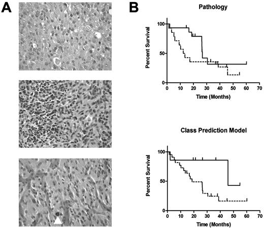 Fig. 3. Characterization of nonclassic, high-grade gliomas. A, histological features of nonclassic, high-grade gliomas. “Brain_NG_1” (top), nonclassic glioblastoma with a region having microgemistocytes that raise the differential diagnosis of anaplastic oligodendroglioma; “Brain_NG_3” (middle), nonclassic glioblastoma with an area of rounded cells that resembles oligodendroglioma and more spindled cells that resemble glioblastoma; “Brain_NO_14” (bottom), nonclassic anaplastic oligodendroglioma with a region displaying the typical branching vasculature and calcification (arrowhead) of oligodendroglioma but with more spindled cells. B, survival curves of patients with the 14 nonclassic glioblastomas (dashed line) and 15 nonclassic anaplastic oligodendrogliomas (solid line). Survival curves were plotted according to classifications based on either traditional pathology or the class prediction model trained on the classic gliomas. When tumors were classified according to pathology, survival of patients with nonclassic glioblastoma was not significantly different from that of patients with nonclassic anaplastic oligodendroglioma (P = 0.194). In contrast, class distinctions according to the class prediction model were significantly different (P = 0.051).