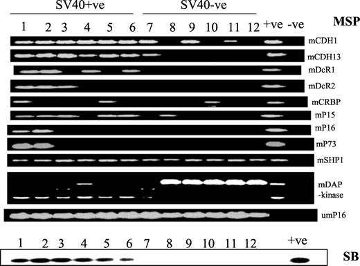 Fig. 1. Representative examples of MSP assay and Southern blot (SB) analysis for SV40 Tag sequences. Data from six SV40-positive (SV40+ve 1–6) and six SV40-negative (SV40−ve 7–12) lymphoma/leukemia cases are illustrated. DNAs were analyzed for the presence of SV40 Tag sequences using primers that amplified a 156-bp region of the large Tag of SV40 (8, 19). The amplicon sequence is specific only for SV40 and not for JC or BK. PCR products were electrophoresed on a 2% agarose gel and visualized by ethidium bromide staining. To confirm the specificity of the PCR products, Southern blotting and sequencing were performed on the resultant amplicons as described in “Materials and Methods.” MSP assay was performed essentially as described by Herman et al. (11). Methylation of death associated (DAP) kinase gene was analyzed using combined restriction analysis (13). The unmethylated form of p16 was run as an internal control for bisulfite treatment. The data show more genes methylated in SV40-positive cases than in SV40-negative cases. SHP1 was methylated in all samples irrespective of methylation status.