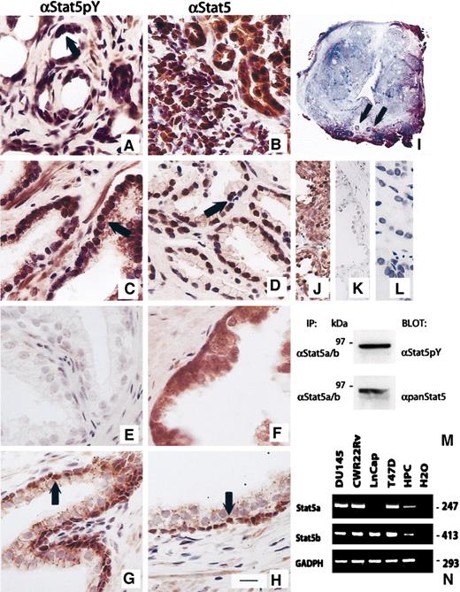 Fig. 1. Signal transducer and activator of transcription 5 (Stat5) is active in human prostate cancer. Paraffin-embedded tissue sections of human prostate specimens were immunostained with a monoclonal activation-state-specific anti-pTyrStat5 antibody (A, C, E, G) and with a monoclonal anti-Stat5 antibody (B, D, F, H). 3,3′-diaminobenzidine was used as a chromogen and Mayer hematoxylin as counterstain. Biotin-streptavidin amplified peroxidase-antiperoxidase immunodetection shows intense positive reactions for active Stat5 in the nuclei of epithelial cells of poorly differentiated prostate cancer acini (Gleason 4 + 5 = 9, patterns 4 and 5 shown; A, B) and moderately differentiated prostate adenocarcinoma (Gleason 3 + 4 = 7, pattern 3 shown; C, D), whereas adjacent normal secretory prostate epithelium was negative for phosphorylated Stat5 (E), and predominant nuclear localization of immunostaining for Stat5 protein was absent (F). Cross-sections of entire prostate (I; cross-sections were taken proximal to verumontanum; arrows point at the ejaculatory ducts) from 11 patients with localized or locally advanced prostate cancer were analyzed by immunohistochemistry for activation of Stat5. Basal epithelial cells of periurethral prostate glands with normal acinar morphology in transition zone stained positively for activated nuclear Stat5 (G, H). Lactating human breast is presented as a positive control tissue (J), and parallel sections of lactating human breast (K) and moderately differentiated human prostate cancer (L) stained with subtype-specific mouse IgG were negative. Stat5a and Stat5b were collectively immunoprecipitated from tissue homogenate of poorly differentiated human prostate cancer sample, resolved on SDS-PAGE, and immunoblotted with a monoclonal anti-phosphoTyr-Stat5 (αStat5pY) antibody (M, top panel). The blot was stripped and reblotted with a monoclonal antibody recognizing both Stat5a and Stat5b (αpanStat5; M, bottom panel). N, reverse transcription-PCR analysis of mRNA from human prostate cancer cells and prostate cancer specimens with Stat5a- and Stat5bspecific primers demonstrated the expression of Stat5a and Stat5b mRNA in human prostate cancer cells (HPC). The reverse transcription-PCR products were size-separated on 2% Tris-borate EDTA-agarose gel. The glyceraldehyde-3-phosphate dehydrogenase gene was amplified in a separate reaction to confirm the integrity of the first-strand cDNA of each sample, and H2O was used as a negative control. A-H and J-L bar, 15 μm. Arrows, positive nuclear immunostaining for activated Stat5 (A and C), nuclear localization of Stat5 protein (D), and positive immunostaining of basal epithelial cells (G and H).