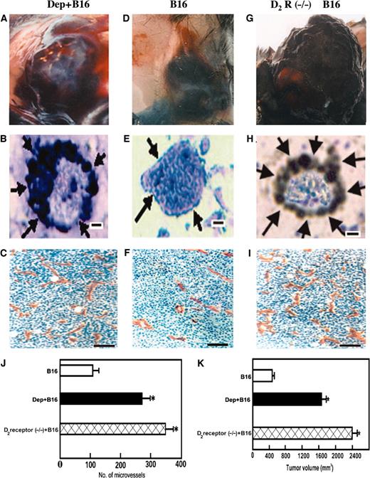 Fig. 1. Effects of ablation of peripheral dopaminergic nerves and D2 dopamine receptor (−/−) on the angiogenesis and growth of B16 melanoma in mice. A–K, gross (A, D, G) and microscopic (including graphical representation; B, C, E, F, H, I–K) appearance of the tumor tissue, 15 days after injection of 1 × 105 B16 tumor cells in 6-hydroxydopamine-induced peripheral dopaminergic nerve-ablated mice, mice with intact peripheral dopaminergic nerve, and D2 dopamine receptor (−/−) mice [D2 R (−/−) + B16]. Mice with ablated peripheral dopaminergic nerve receiving B16 tumor (Dep+B16 (A); Dep+B16 (J)] exhibited significantly increased angiogenesis, microvessel density (A, C, J), and increased microvascular permeability of many enlarged mother vessels, as determined by their labeling with extravasated colloidal carbon (black arrows, B), when compared with angiogenesis, microvessel density (D, F, J), and microvascular permeability of enlarged mother vessels as determined by their labeling with extravasated colloidal carbon (black arrows, E) observed in B16 tumor-bearing mice with intact peripheral dopaminergic nerve. Tumor volume was also significantly increased in these peripheral dopaminergic nerve-ablated mice when compared with intact peripheral dopaminergic-nerve control mice (A, D, K). Also, B16 melanoma-bearing mice with D2 dopamine receptor (−/−) exhibited significantly increased angiogenesis, microvessel density (G, I, J), and microvascular permeability of the enlarged mother vessels, as determined by their labeling with extravasated colloidal carbon (black arrows, H), and tumor volume in these knockout mice was significantly increased when compared with B 16-bearing mice with intact peripheral dopaminergic nerves (D, G, K). Error bars, ∗, P < 0.01 with regard to intact peripheral dopaminergic nerve-intact mice. Scale bars: C, 100 μm; F, 100 μm; I, 100 μm; B, 10 μm; E, 10 μm; H, 10 μm.