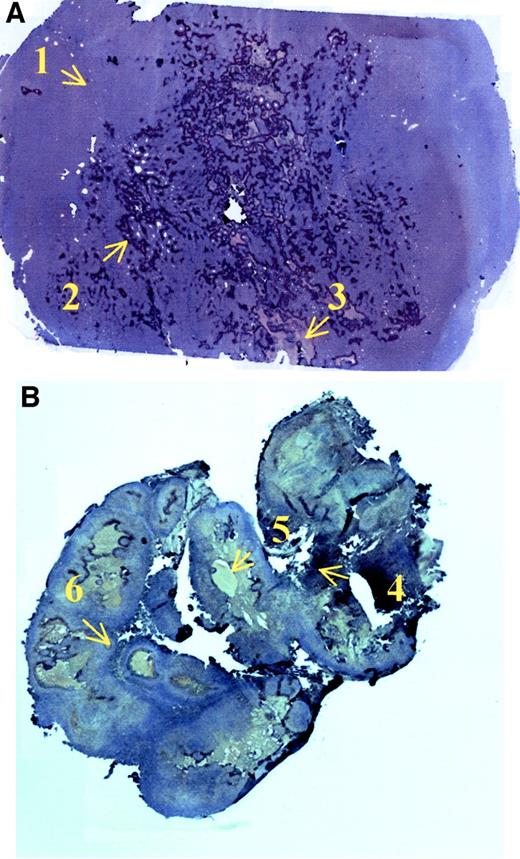 Fig. 2. Examples of pimonidazole staining in FSA (A) and 9L (B). FSA shows large regions of moderate hypoxia (arrow 1) and regions of well-oxygenated tissue. There are also small patches of severe hypoxia (arrow 2), and some necrosis (arrow 3). 9L pimonidazole staining shows large patches of severe hypoxia (arrow 4) and necrosis (arrow 5). There are also regions of severe hypoxia very close to well-oxygenated regions (arrow 6).