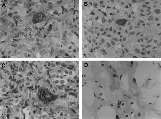 Fig. 6. Antitumor effect of ritonavir, docetaxel, or the combination of both in vivo. After 6 weeks of therapy with ritonavir and docetaxel either alone or in combination (as described in Fig. 5<$REFLINK>), tumors were removed from BNX triple-immunodeficient mice, fixed, and stained (H&E). A, DU145 control tumor has poorly differentiated carcinoma cells without necrosis (original ×200). B, DU145 tumors from mice treated with ritonavir (10 mg/kg/day) for 6 weeks. The histology appears similar to control tumors (A; original ×200). C, DU145 tumors from mice treated with docetaxel (25 mg/kg/day) for 6 weeks. Portions of the tumor show tumor necrosis (original ×200). D, DU145 tumors from mice treated with the combination of ritonavir (10 mg/kg/day) and docetaxel (25 mg/kg/day) for 6 weeks show extensive tumor necrosis and fibrotic changes (original ×200).