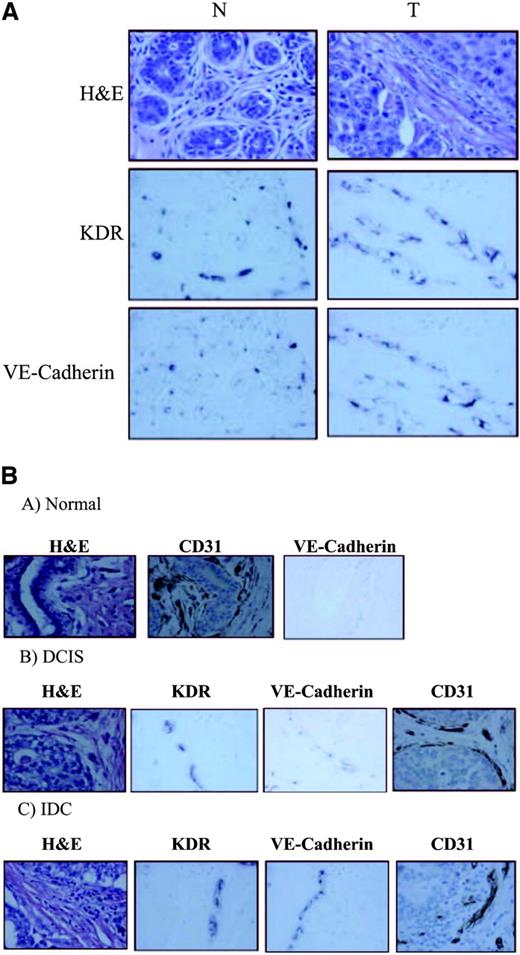 Fig. 3. In situ hybridizations for VE-cadherin expression. A, mixtures of KDR and VE-cadherin riboprobes were hybridized to a breast tissue array containing normal (N) and tumor (T) sections. Arrays were also H&E stained to determine the presence of normal or tumor epithelium and, hence, the location of tumor endothelium. B, a breast tumor sample that contained regions of normal breast (A), ductal carcinoma in situ (DCIS; B), and invasive ductal carcinoma (IDC; C) on the same section was stained with H&E, KDR, or VE-cadherin riboprobes or with CD31 antibodies. Results were visualized ×40.