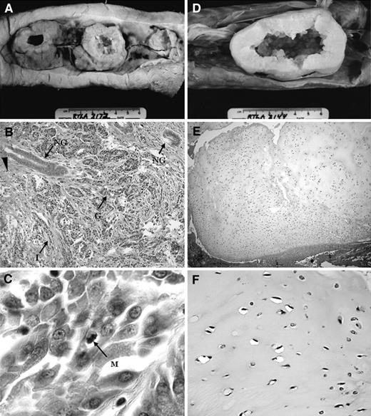 Fig. 1. A malignant kidney tumor (A–C) and a benign cartilage tumor (D–F) from spiny dogfish sharks (Squalus acanthias) found off the coast of Maine and donated to the Registry of Tumors in Lower Animals via the Maine Department of Natural Resources. A–C, a renal cell carcinoma from a RTLA case 3172 collected in 1984. A, ventral view of the submitted specimen, consisting of a 15-cm section of formalin-fixed skinless dorsal body wall with attached kidney. The masses protruded ventrally from the kidney and consisted of four contiguous, 1.0- to 2.5-cm masses of the same color and texture as normal kidney with confluent areas of necrosis. Sectioning revealed the hollow interior of the left and central masses (A). B, medium power view showing invasion of normal renal parenchyma. NG, normal glandular structures, most likely renal tubules. G, irregular glands formed by the tumor cells. I, rows of single malignant tumor cells invading stroma. Arrowhead, necrosis. The malignant cells contain similar pink refringent cytoplasmic bodies as in normal kidney tubules, consistent with renal origin (×200). C, high power view of renal carcinoma. M, mitosis (×1000). D–F, chondroma (RTLA case 3144). D, ventral view of the submitted 13-cm segment of dorsal body wall containing a 7.0 × 3.6 cm, oval, hollow mass projecting ventrally into the peritoneal cavity. The neoplasm was attached to the normal vertebral cartilage (data not shown). E, low power view showing the nodularity of the tumor. Compared with the normal cartilage, the mass has increased cellularity and a loosely fibrinous texture, and lacks the calcified perimeter apparent on normal vertebral cartilage (×50). F, high power view of the chondroma showing irregularly placed cartilage cells in an immature cartilagenous matrix (×500).