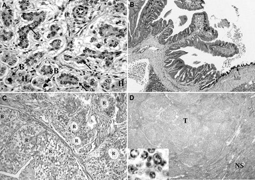Fig. 2. Four other representative chondrichthyan malignancies. A, cholangiocarcinoma from a blue shark, Prionace glauca (RTLA case 7300). Arrows, malignant bile ducts; H, hepatocytes; B, bile accumulations in hepatocytes (×750). B, mesothelioma on the surface of the liver of the same blue shark as A. The tumor comprising the left two thirds of the image has a well-differentiated columnar epithelium in a convoluted, papillary architecture. Me, normal mesothelium (×25). C, olfactory neuroblastoma from the head of a spotted ratfish, Hydrolagus collei (RTLA case 3409). R, Rosette (×400). D, nodular (predominantly large cell) follicular lymphoma, grade 3, from a sandbar shark, Carcharhinus plumbeus (RTLA case 523), originally diagnosed as a reticulum cell sarcoma. T, tumor; NS, normal spleen (×25). Inset, ×800.