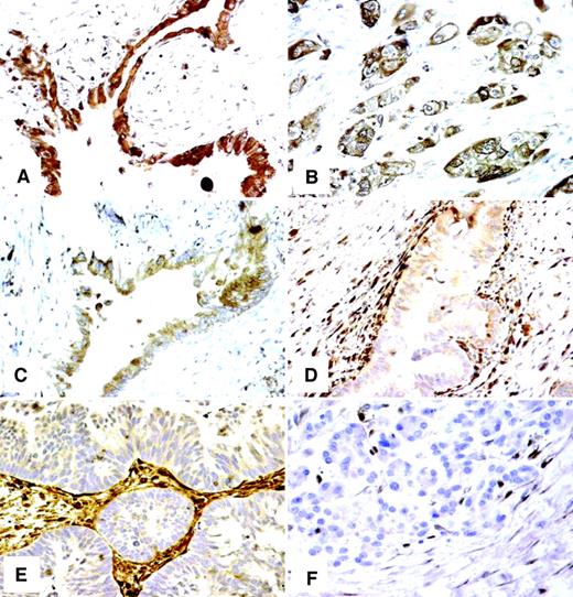 Fig. 4. IHC detection of α-enolase (A), cathepsin D (B), calreticulin (C), and galectin-1 (D–F) in pancreatic adenocarcinoma (A--E) and normal adjacent tissues (F). α-Enolase, cathepsin D, and calreticulin were predominantly expressed in the ductal epithelial cells, whereas galectin-1 was expressed more strongly in the stroma immediately adjacent to the tumor than in the tumor (D). Some tumor cells were negative for galectin-1 staining, but the immediate adjacent stroma showed strong positive staining (E). Galectin-1 expression was barely detectable in distant normal pancreas tissues (F).