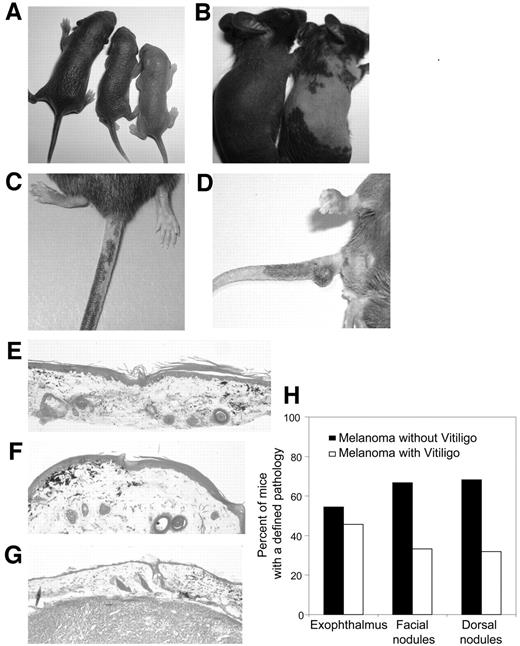 Fig. 1. Spontaneous vitiligo in MT/ret melanoma mice. Features of vitiligo and correlation with tumor growth suppression. A–D, photographs of MT/ret transgenic mice. Pigmentation of the whole skin after birth (A, 1–5-day-old littermate mice). The melanosis is homogeneous in newborn (A) and in adult (B, left mouse) mice. In B–D, depigmentation occurs on the back (B, right mouse) and on the tail (C and D). Note a small tumor nodule on the depigmented tail (D). E and F, skin biopsy specimens at the margin between the normal and vitiliginous tail skin of the 30-week-old mouse in C were stained with Fontana-Masson (×125). Melanin-containing cells are abundant in the dermis and epidermis of the pigmented skin, and only a few such cells are detectable in the deep dermis of the depigmented zone. G, biopsy of a cutaneous nodule consisting of melanoma cells stained with Fontana-Masson (×125). The upper dermis nodule shows melanin-producing cells on the right, in contrast with absence of pigments on the left. H, comparison of the percentage of 6-month-old mice with melanoma alone (n = 43) or with melanoma-associated vitiligo (n = 45) that presented defined clinical signs (exophthalmus, facial and dorsal nodules). No significant difference in exophthalmus incidence was found when melanoma mice (n = 31), and mice with melanoma-associated vitiligo (n = 26) were compared (χ2 test, P = 0.095). In contrast, facial nodules were significantly more frequent in melanoma mice (n = 20) than in mice with melanoma-associated vitiligo (n = 10, P = 0.012). Similar data were obtained with dorsal nodules that were also significantly more frequent in melanoma mice (n = 15) than in mice with melanoma-associated vitiligo (n = 10, P = 0.03).